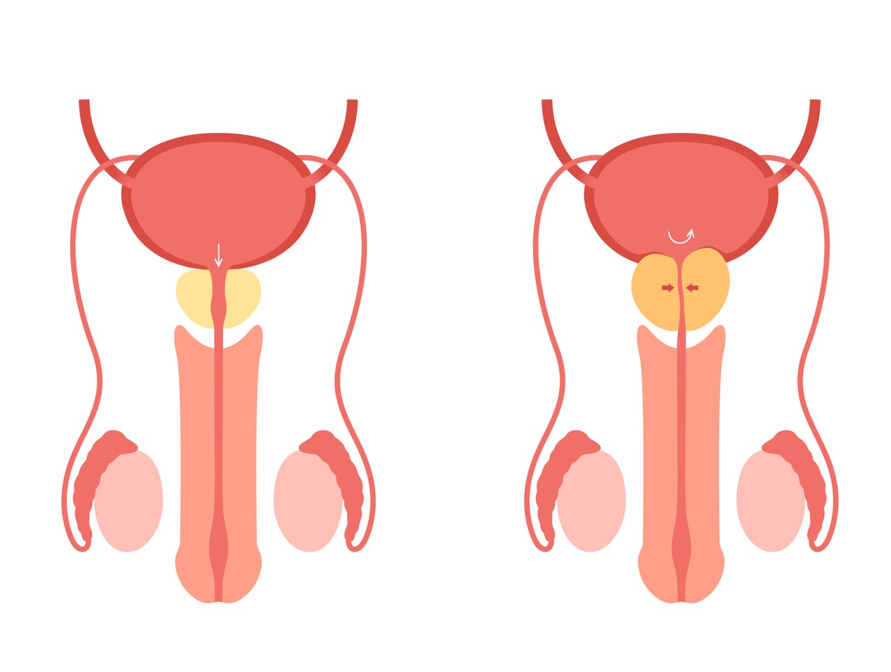 Hiperplasia benigna da próstata