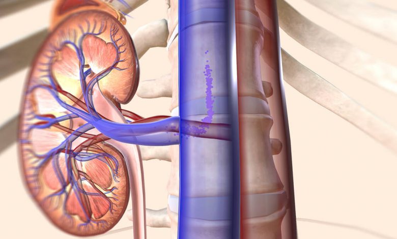 Cirurgia para câncer de rim quando optar por nefrectomia parcial ou total
