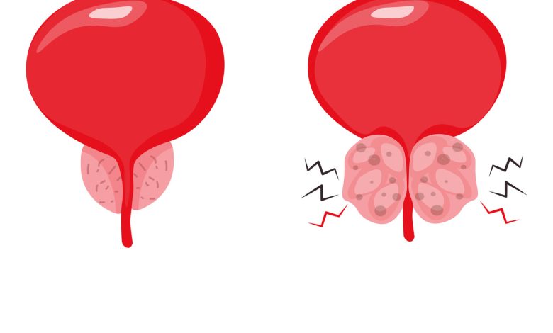 Dificuldade para urinar? Conheça o método HOLEP e recupere sua qualidade de vida