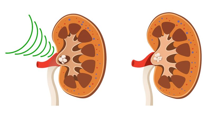 Livre-se das pedras nos rins sem cirurgia.