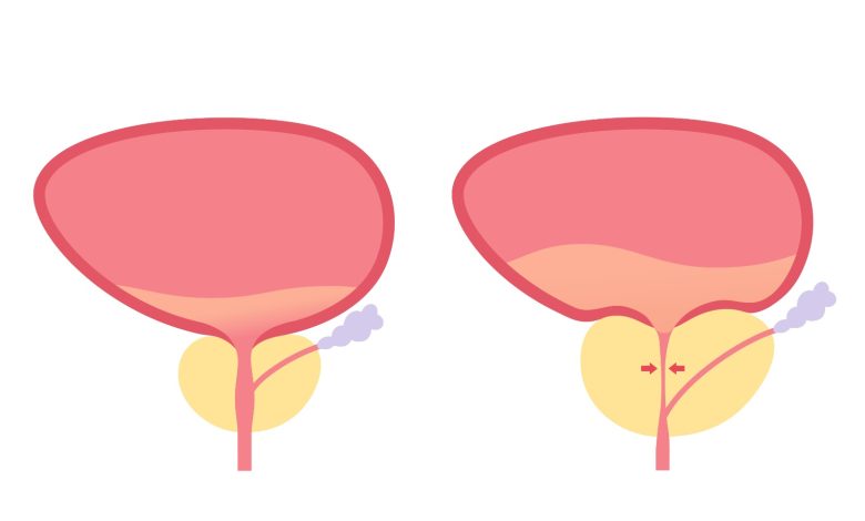 Sintomas parecidos, diagnósticos diferentes como saber se é HPB ou prostatite